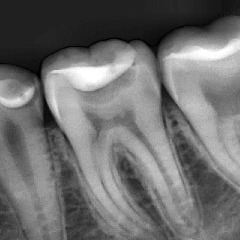 Bondent Bondream Sensor - Dental Intraoral Digital Sensor